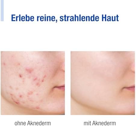 aknederm Tinktur 50ml - mit Lactic Acid/Milchsäure (AHA) und Salizylsäure (BHA) - sanfte porentiefen Hautreinigung für t