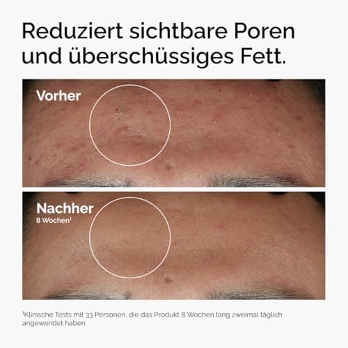 THE ORDINARY Niacinamid 10% + Zink 1% - Erfolgreiches Reinigungs- und Sommerspfefullyon Produkt für Misshalt und Überpr