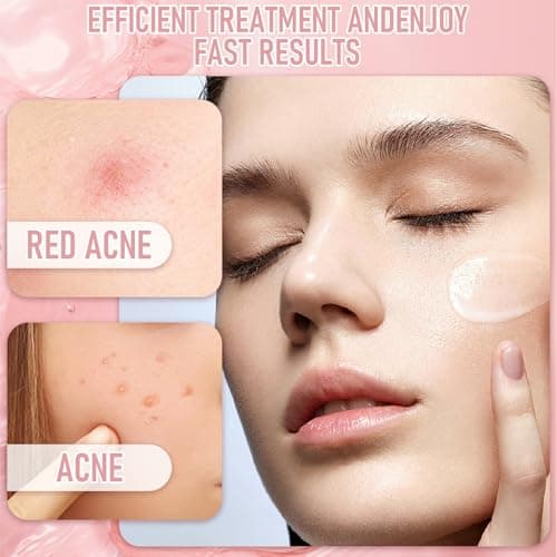 12% Azelaic Acid Serum, Effektives Gegen Pickel & Dunkle Flecken für Sensible Haut, Hautaufheller mit Hyaluronsäure
12%