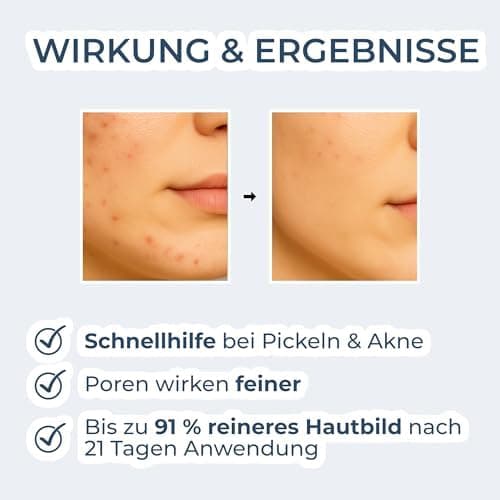 VIGOROUS® Zink Gesichtswasser 120ml anti Pickel Männer & Frauen - Salicylsäure & Niacinamide face cleanser gegen unreine