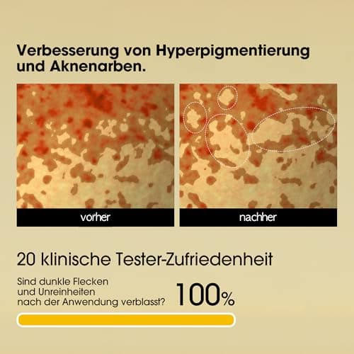 SOME BY MI Yuja Niacin Anti Blemish Serum - 10% Niacinamid & Vitamin C - Für reife Frauen - Perfekter für Nacht- & Morge