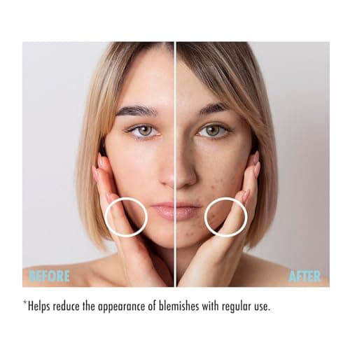 Maruderm Azelainsäure Serum 10% - Reinigung & Rotungen verringern - Balancierend für Mischhaut und empfindliche Haut - 3