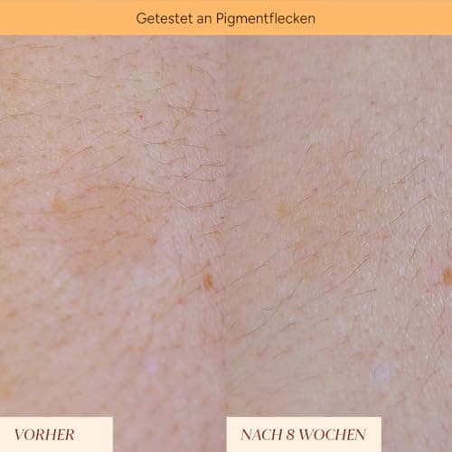 JUNGLÜCK Anti Pigmentflecken & Pickelmale Roll-On - Vegan - Speziell für reife Haut - Einfach rollen für einen strahlend