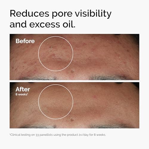 THE ORDINARY Niacinamid 10% + Zink 1% - Erfolgreiches Reinigungs- und Sommerspfefullyon Produkt für Misshalt und Überpr