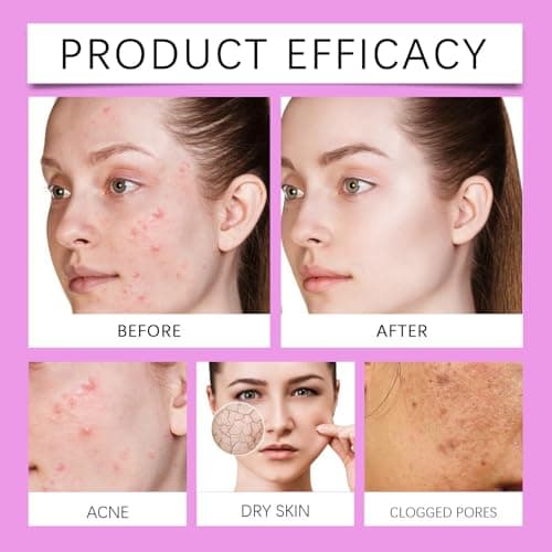 12% Azelainsäure Serum für Gesicht, Hautfettabbau und glatte Haut
| Hyaluronsäure Serum & Niacinamid für gesunderes Ges