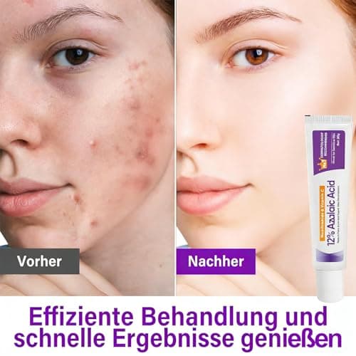 12% Azelaic Acid Serum - Anti-Pickel-Creme für rosAceatische Haut
| Azelainsäure Serum - Porenverkleinerung & Pickelred