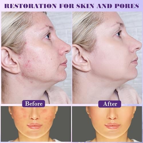 12% Azelaic Acid Serum, Gesichtsserum gegen Rötungen für sensible Haut, Aufgehellte Haut mit Azelainsäure und Hyaluronsä