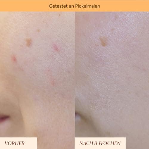 JUNGLÜCK Anti Pigmentflecken & Pickelmale Roll-On - Vegan - Speziell für reife Haut - Einfach rollen für einen strahlend