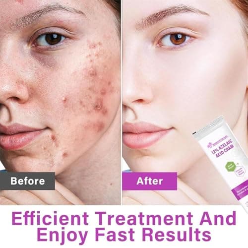 12% Azelainsäure Serum für Gesicht, Hautfettabbau und glatte Haut
| Hyaluronsäure Serum & Niacinamid für gesunderes Ges