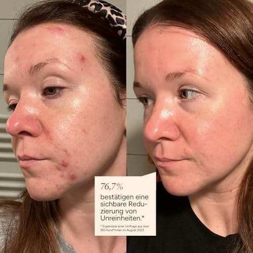 JUNGLÜCK Azelain Serum - Vegan, beruhigendes Gesichtsserum gegen Pickel & Rötungen - Azelainsäure reduziert Pigmente, Pi